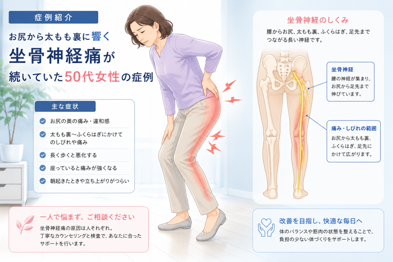 お尻から太もも裏に響く坐骨神経痛が続いていた50代女性の症例